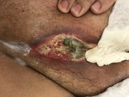 luchevoy-dermatit-01.jpg