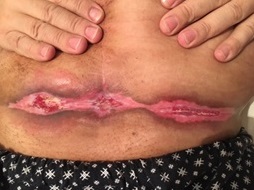 luchevoy-dermatit-04.jpg