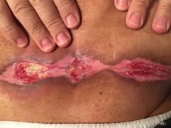 luchevoy-dermatit-03.jpg